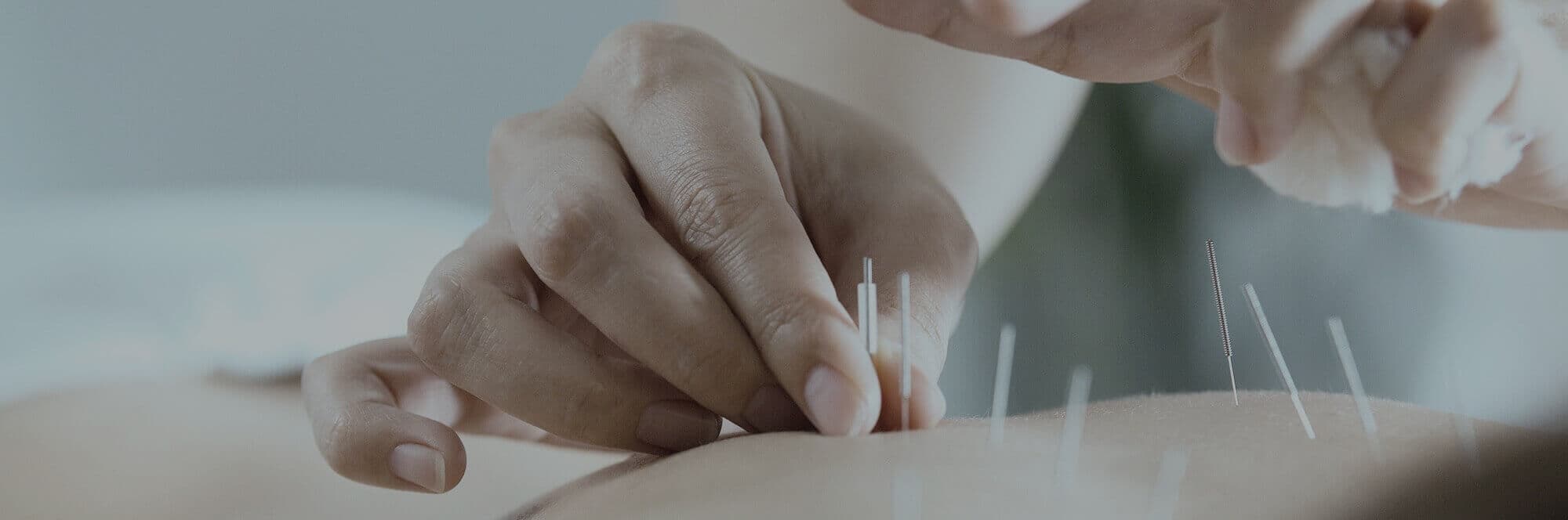 Acupuncture Treatment